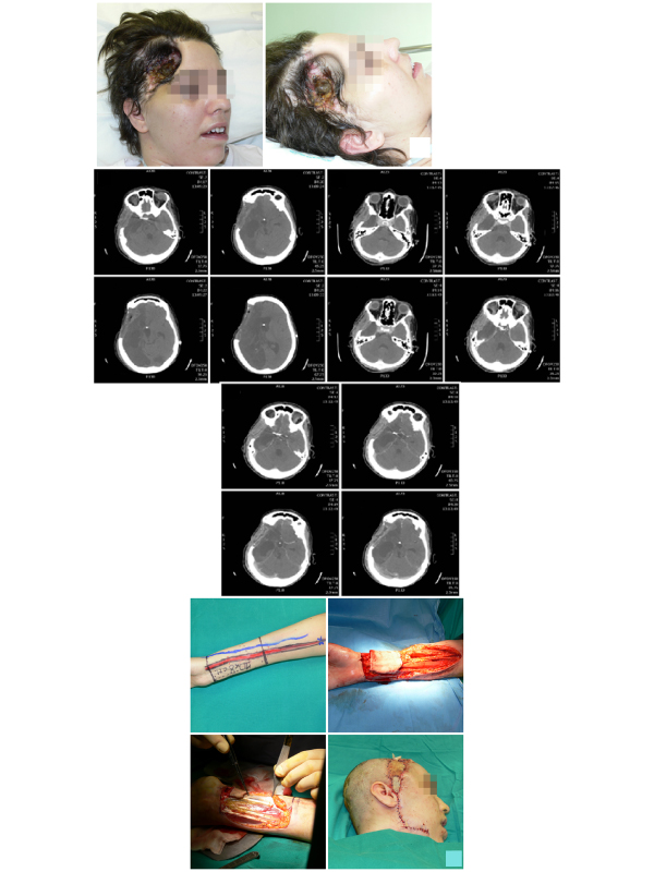 Frontoparietal Cranial Loss of Substance: CT Study and Microsurgical Reconstruction with Radial Flap.