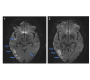 Hypoglycemic Encephalopathy: A Neurologic Manifestation of Hypoglycemia