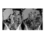 Inferior Mesenteric Vein Thrombosis