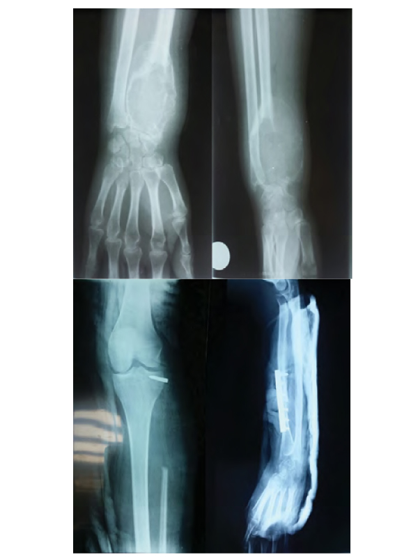 Giant Cell Tumor of the Distal Radius Treated by Free Fibular Transfer