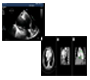 Giant Left Ventricular Pseudoaneurysm