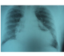 Hydropneumopericardium: Followed by Partial Pericardiectomy