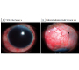 Traumatic Subconjunctival Dislocation of Intraocular Lens