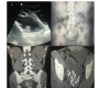 Stone in Ectopic Pelvic Pancake Kidney: A Surgical Challenge