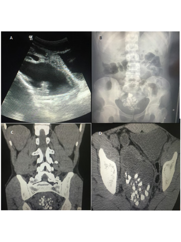 Stone in Ectopic Pelvic Pancake Kidney: A Surgical Challenge
