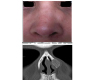 Nasal Intraosseous Hemangioma: A Honeycomb Lesion