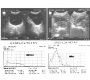 Combined Effects of Constitutional and Organopathic Homeopathic Medicines for Better Improvement of Benign Prostatic Hyperplasia Cases