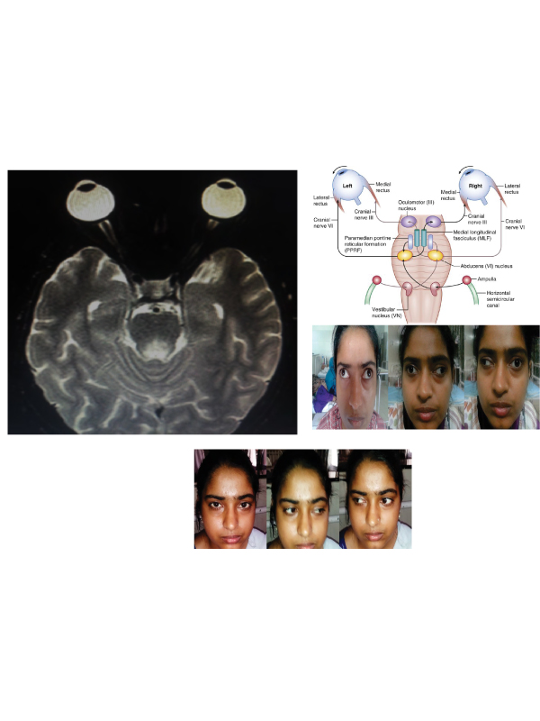 Webino Syndrome (Wall-Eyed Bilateral Internuclear Ophthalmoplegia)