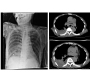 Traumatic Oesphageal Perforation