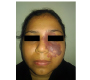 A Final Diagnosis of Port Wine Stain or Nevus Flammeus