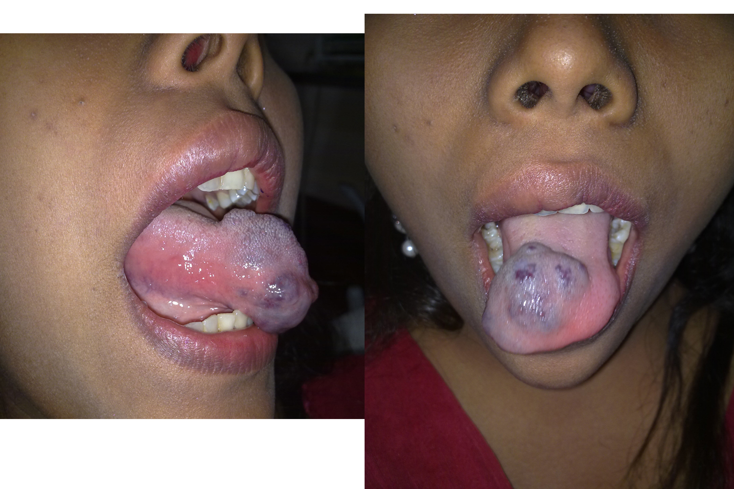 Hemangioma of Tongue