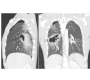 Chest CT Results in Diagnosis of Post-traumatic Haemato Pneumatocele