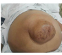 Marked Abdominal Ascites with Supraumbilical Hernia