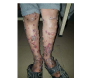 Diagnosis of Bullous Pemphigoid by Haematoxylin and Eosin Staining
