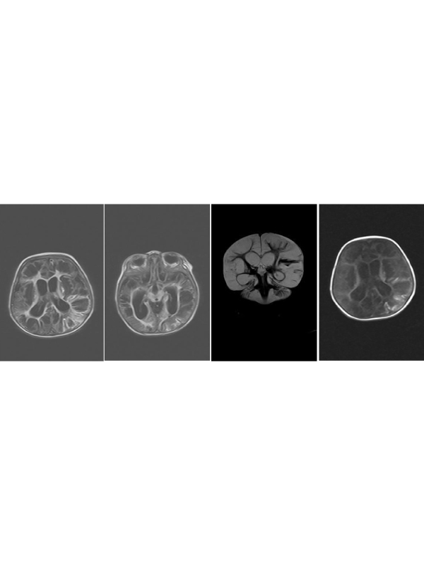 Cytomegalovirus Encephalitis in an Infant; MRI Manifestation: A Clinical Image