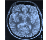 Starry Sky: Neurocysticercosis, an Old Disease