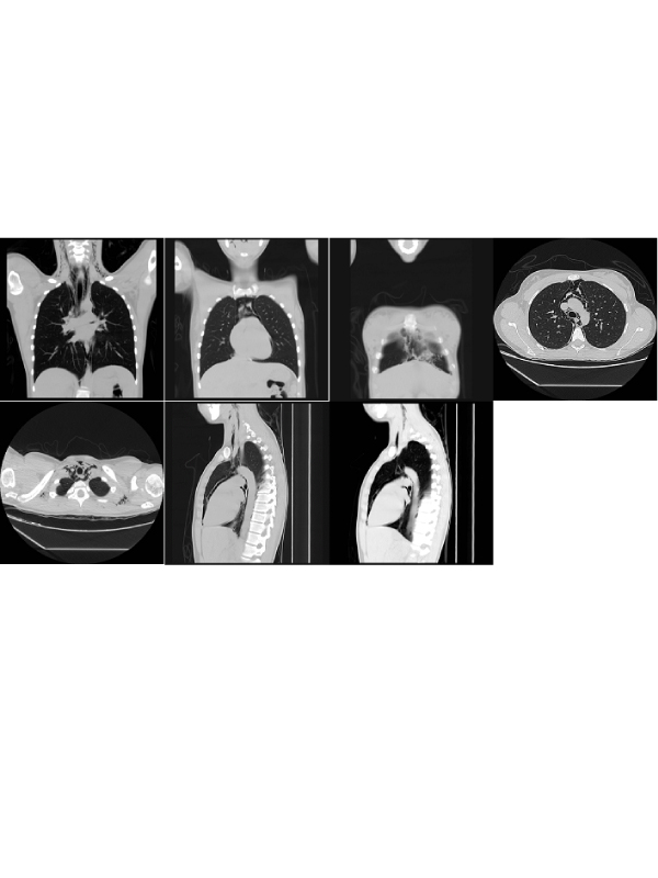 Pneumomediastinum in a Young Previously Healthy Patient with Odynophagia: An Incidental Finding in the Emergency Room