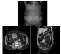 Abdominal Gossypiboma: A Diagnostic Dilemma in Late Postoperative Period