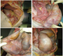 Faecal Impaction with Deadly Outcome
