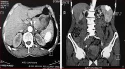 Splenic Hydatid Cyst Calcified