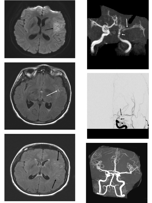 A Young Woman with Sudden Hemiparesis