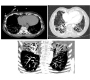 Lung Disease in Primary Ciliary Dyskinesia