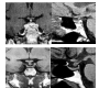 Pituitary Stalk Thickening