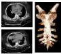 An Anatomic Abnormality: Double Sternal Foramina