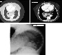 Para-Esophageal Hiatal Hernia with entire Stomach within the Chest