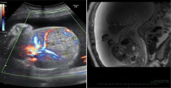 Foetal Hepatoblastoma