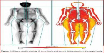 Etiologic Diagnosis by DXA in Diabetes Mellitus