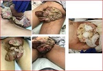 Fungating Stage-4 Penile Squamous Cell Carcinoma