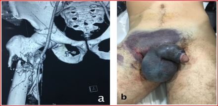 Gunshot Injury Causing Vascular, Bone and Genital Damages