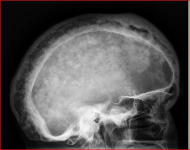 Cotton wool appearance (bone), Radiology Reference Article