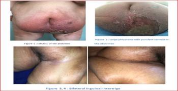 Cellulitis: Frequent Clinical Entity with Atypical Location
