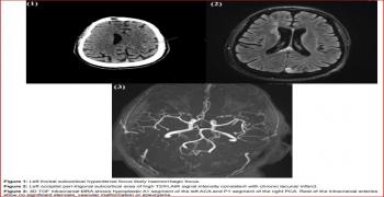 Neuroradiological Findings in Catastrophic Antiphospholipid Syndrome: A Case Image Report