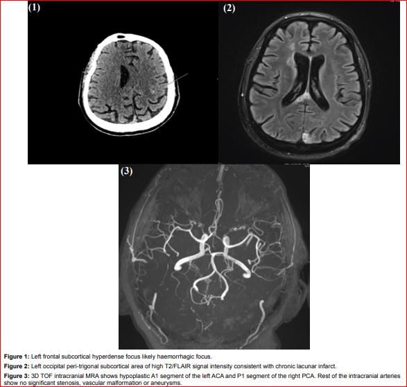 Neuroradiological Findings in Catastrophic Antiphospholipid Syndrome: A Case Image Report