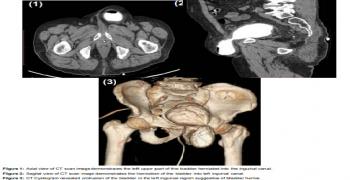 A Rare Cause of Inguinal Herniation: Urinary Bladder Hernia