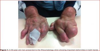 Severe Gout