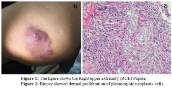 Stewart Treves Syndrome: A Life Threatening Complication of Chronic Lymphedema