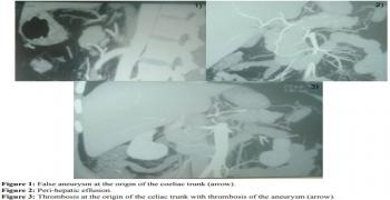 Post-traumatic Pseudoaneurysm of the Coeliac Trunk with Spontaneous Evolution Favorable