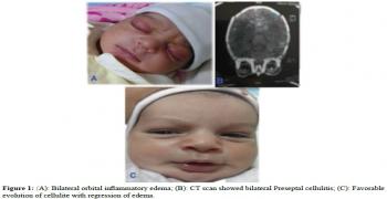 Preseptal Cellulitis In A Neonate