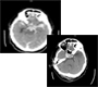 Traumatic Subarachnoid Hemorrhage and Contusion