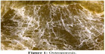 Osteoporosis