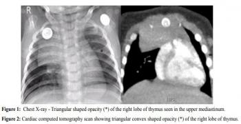 Thymic Sail Sign