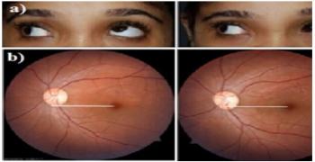 Importance of Photographic Evaluation in Oblique Muscle Surgery