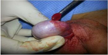 Torsion of the Testicular Appendix