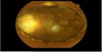 Disc within Macular Coloboma