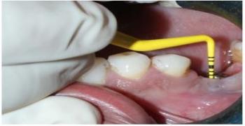 Treatment of Peri-implantitis with Implantoplasty and Diode Laser