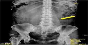 Huge Ovarian Borderline Mucinous Cystadenoma